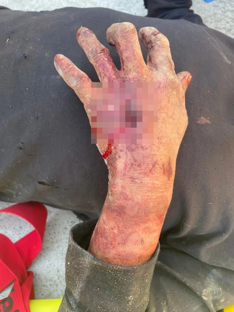 羅姓男子手掌被山豬撕咬貫穿。民眾提供