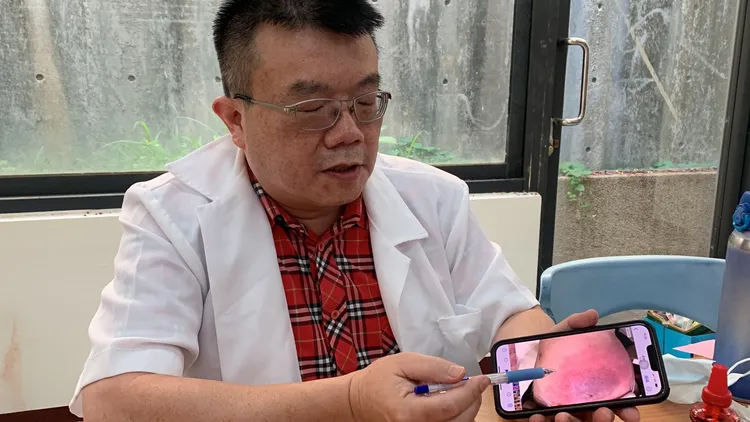 醫師提醒，接受幹細胞治療要找有培養萃取幹細胞技術的醫學中心，避免併發蜂窩性組織炎。曾雪蒨攝