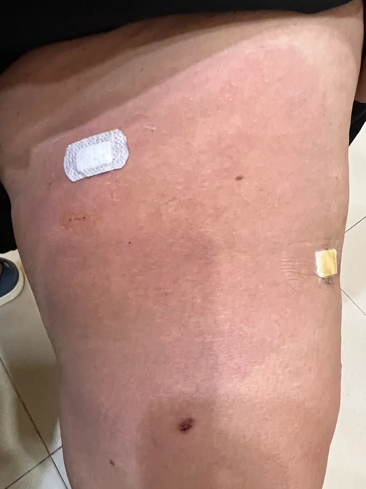 緊急施打合併口服三天抗生素，患部終於消腫消炎恢復正常。施勝桓醫師提供