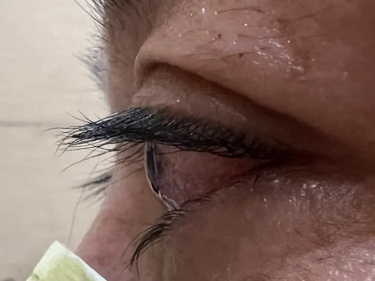 台中婦人打幹細胞治療膝關節痛，未料膝關節沒好眼睫毛莫名其妙長得濃長密。曾雪蒨攝