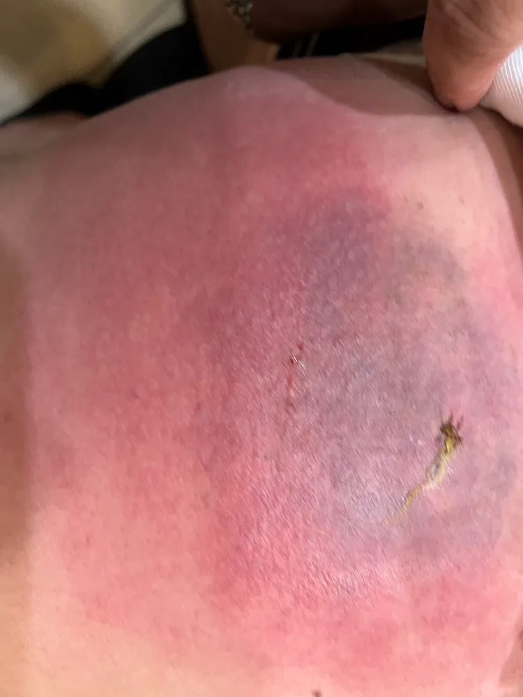 患者施打異體幹細胞的左大腿部位不但紅腫還留出滲出液。施勝桓醫師提供