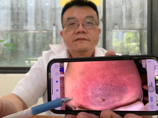 幹細胞治療膝蓋痛沒有好 貴婦大腿腫像麵龜、睫毛濃密像貝蒂