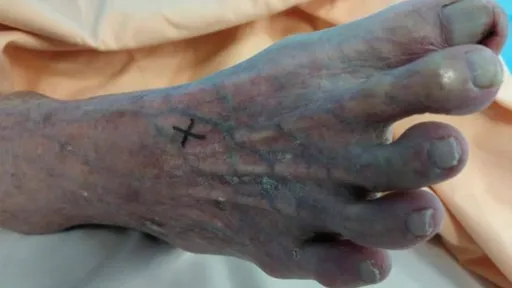 高雄婦左腳黑如「烏骨雞」冰又麻 腳中風!再晚6小時就截肢