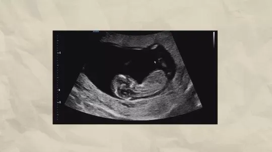 尹勝雅公開寶寶的超音波照片，和大家分享喜悅。翻攝尹勝雅IG