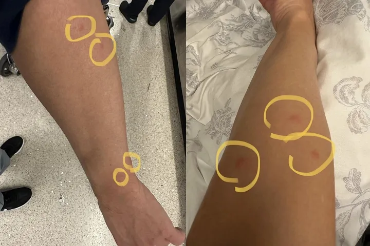 男網友PO出老闆手臂的照片，指控是在飛機上被跳蚤咬。翻攝爆料公社