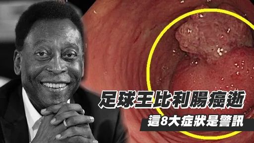 足球王比利腸癌逝 醫鐵口台灣「明年病例暴增」!這「8大症狀」是警訊