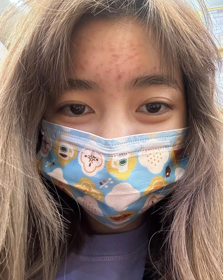 林玉書自爆變「爛臉」搶救中。翻攝自林玉書IG