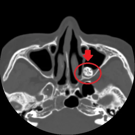 醫師透過MRI影像檢查發現鼻腔內竟「長」出一顆牙齒。亞大醫院提供