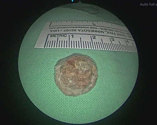 鼻血鼻涕10年流不停、脾氣暴躁 婦檢出2公分牙齒藏鼻腔