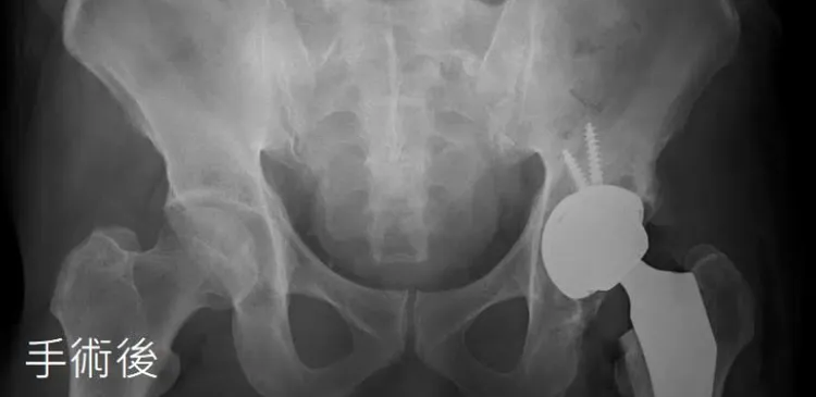 林男經置換人工髖關節後3天即可出院。亞大醫院提供