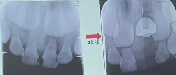 5歲女童2年未回診，恆門齒萌發路徑180度大旋轉。賴昀岫攝