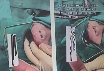 新冠肺炎搗亂!5歲女童蛀到蜂窩性組織炎 全身麻醉拔9顆牙