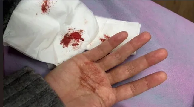 手拿下來是一攤血，看起來相當驚人。翻攝Dcard