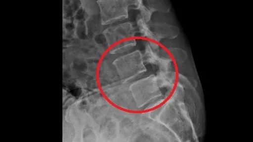 婦脊椎滑脫腰痛腳麻 支架撐開穩定脊椎降低骨傷害