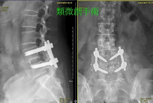七旬老翁忍背痛到腿軟才求醫 他用健保手術助他「掰咖變勇咖」