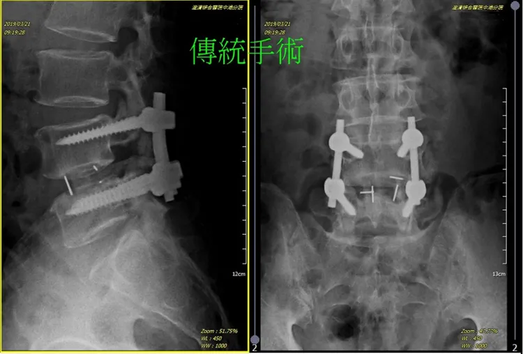 傳統手術傷口大，恢復期短。中港澄清醫院提供
