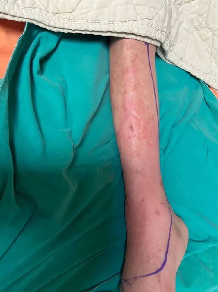 院方事後開出死亡原因為疑似右腳傷口感染併發右下肢蜂窩性組織炎。投訴人提供