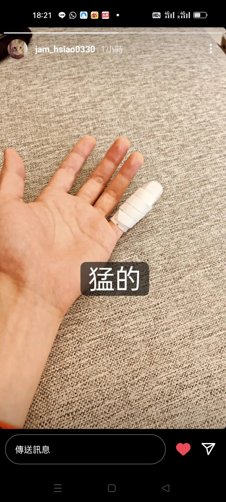 蕭敬騰今曬出手包紮的照片。翻攝蕭敬騰ig限動