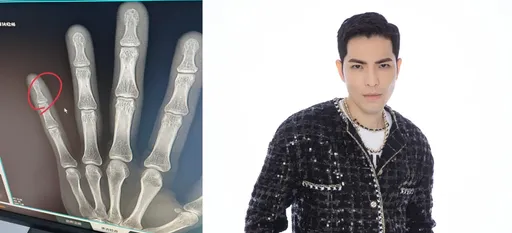 蕭敬騰舊傷復發!骨裂肌肉恐萎縮 堅持不打鋼釘原因曝光