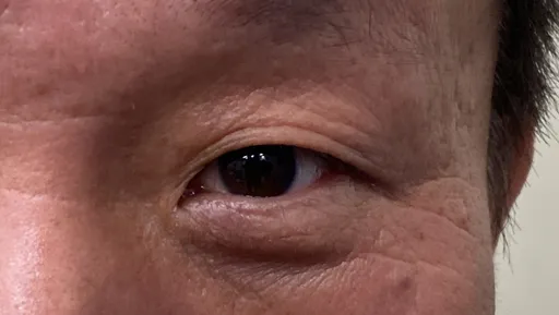 6旬伯畏光淚流不止眼刺痛 脈衝光治癒乾眼症