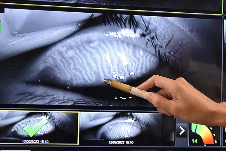 阿伯瞼板腺阻塞擠不出或只擠出少許牙膏狀瞼脂。院方提供