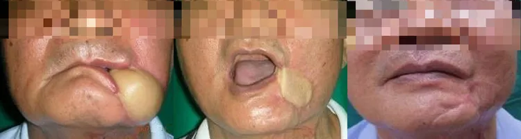口腔癌患者經高醫外科團隊運用新式儀器治療後，原本嘴巴掛著一團肉，明顯恢復正常(從左至右)。高醫提供
