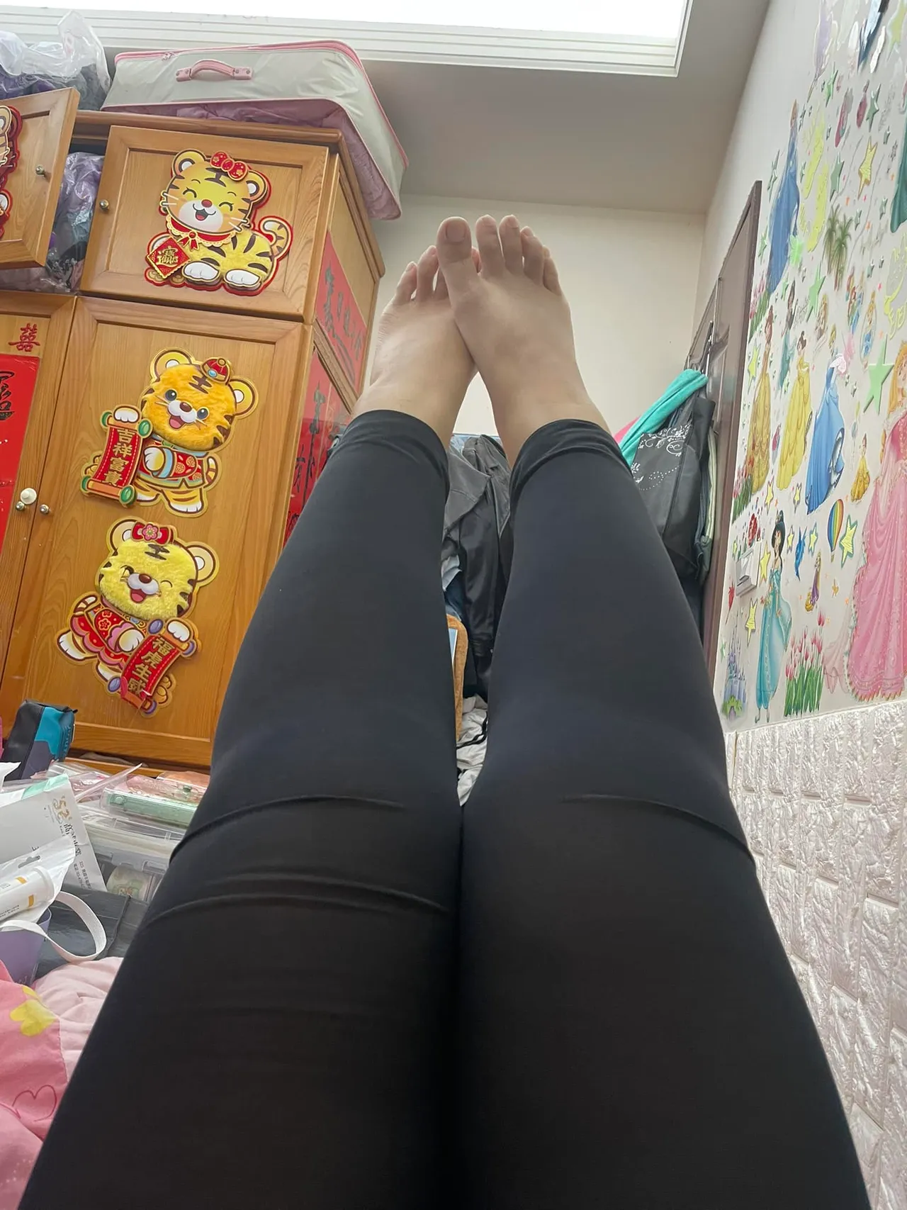 双腿抽脂后十天,因为组织液,双腿仍是肿胀状态。引自美妆公社