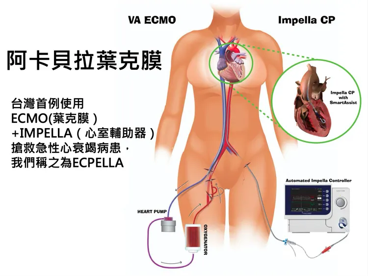 阿卡貝拉葉克膜示意圖。北榮提供