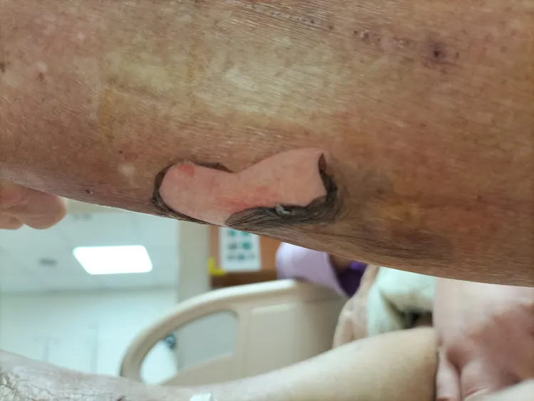 有長者使用暖暖包，卻被皮膚燙到焦黑，有長達10公分的皮膚脫落。引自蘇一峰臉書