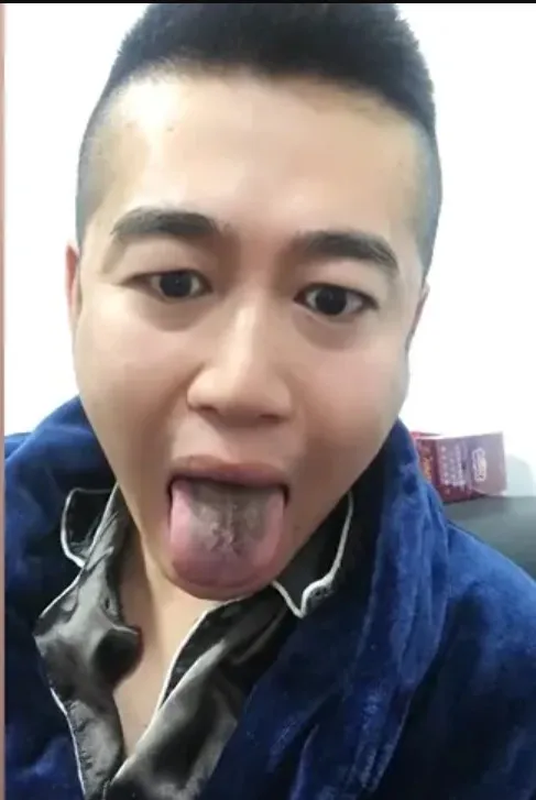 天津男子確診後舌頭變黑。翻攝微博