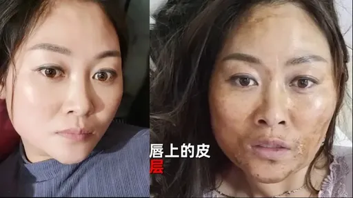 中國確診臉舌發黑染新變種? 醫:極罕見!病毒攻擊「這部位」致膚色暗沉