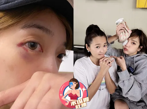 木瓜霞|貝童彤慘遭六月K成黑青臉 女星靠臉吃飯心疼餒