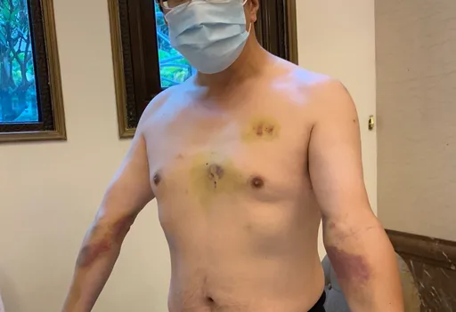 47歲男寒流慢跑呼吸心跳全停 他10年3度心肌梗塞!醫師點破生死教訓