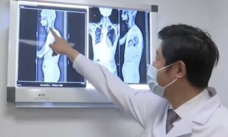 醫生表示，小胡患上的是脊柱大塊骨質溶解症。翻攝微博