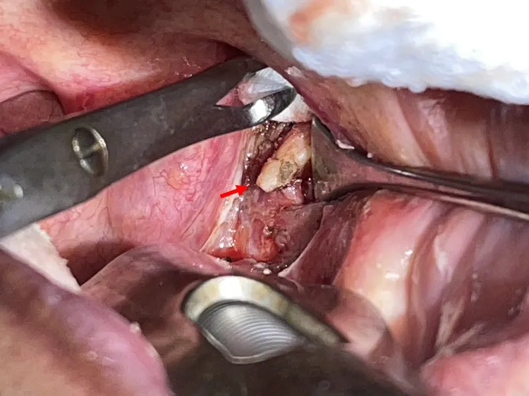 男子扁桃腺後方的扁桃窩，出現不該有莖突（箭頭），這根骨頭讓男子喉嚨老是卡卡的，吞嚥不順。侯思任醫師提供