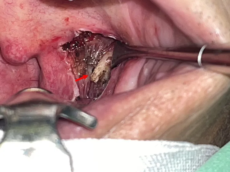 這根骨頭讓男子喉嚨老是卡卡的，吞嚥不順。侯思任醫師提供