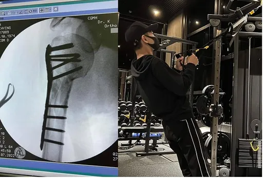 林志穎自撞車禍近5個月賣力復健　秀最新狀態鈦合金鋼板手