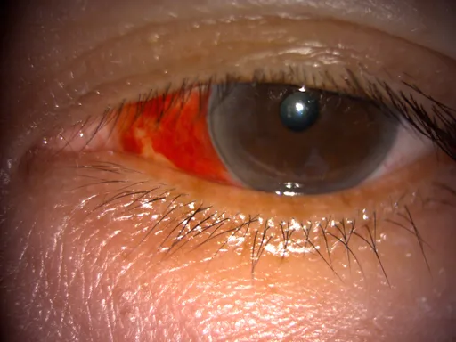 6旬翁眼白大出血!竟是便祕害的 日常「6個小動作」恐惹禍