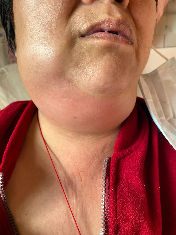 患者拔牙後發燒、頸部腫痛，到花蓮慈濟醫院急診就醫，確診後為深頸部感染，致死率高達五成。花蓮慈濟醫院提供