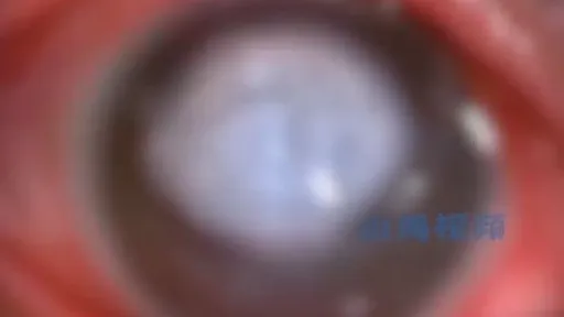 新婚夜忘摘隱形眼鏡　新郎「眼球一夜變白目」險成獨眼龍