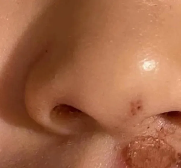 張恆指兒子鼻子下有疑似被菸燙傷的傷疤。翻攝網易娛樂