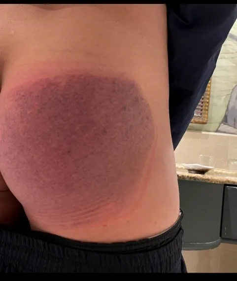 臀部大面積瘀青。翻攝自「爆料公社公開版」