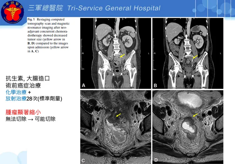 患者腫瘤顯著縮小。三總提供
