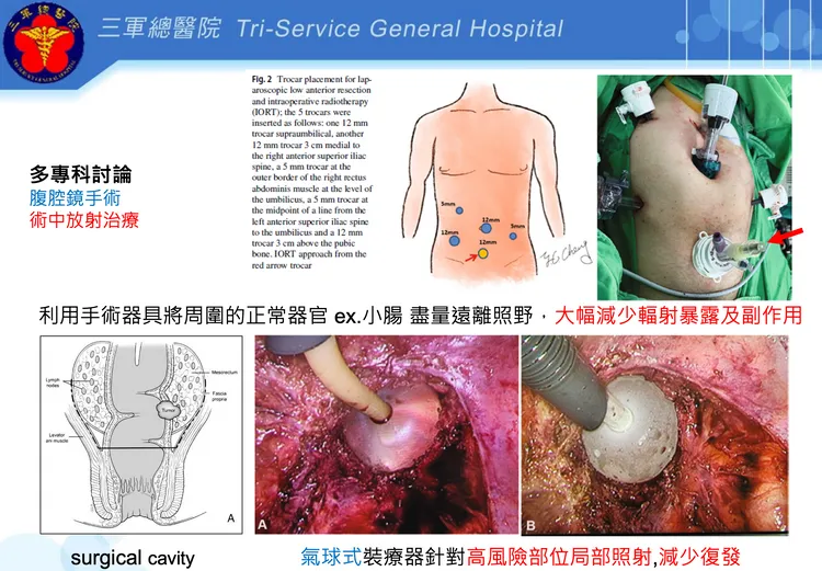 術中放射治療搭配腹腔鏡手術。三總提供

