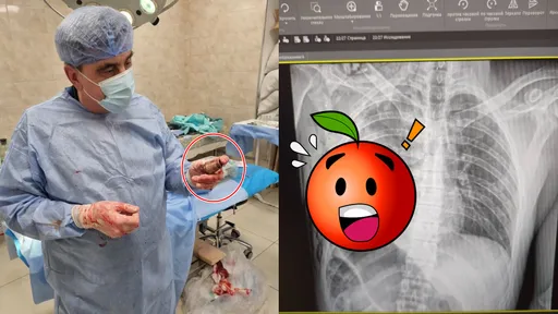 烏克蘭士兵心臟下方卡手榴彈　隨時爆炸！醫生妙手取出