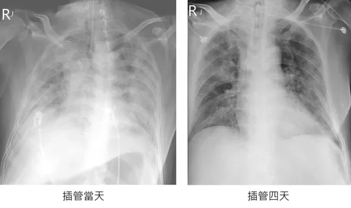 台商「大白肺」仍插管中!定序出炉了 指挥中心点出「重症主因」