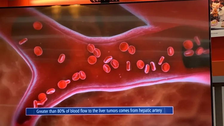 玻璃釔 90 微球治療方式，是從病患鼠蹊部股動脈，經導管將微球注入肝臟，可有效殺死癌細胞縮小腫瘤面積，切除後仍可保留健康肝臟維生。曾雪蒨攝