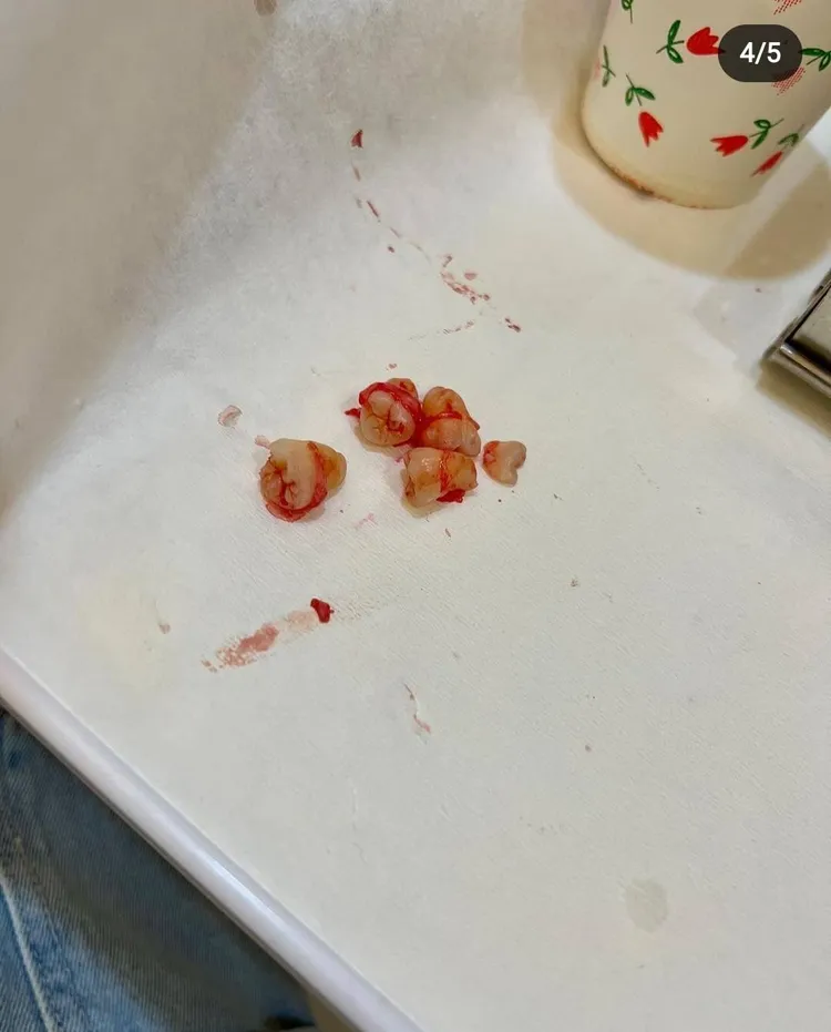 血淋淋的4顆智齒。翻攝葉羿君IG