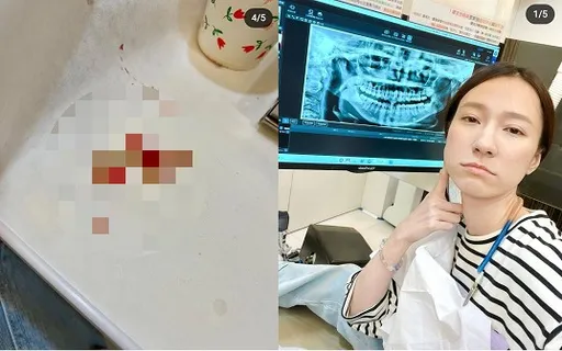 女星1次拔4顆智齒臉超腫 8小時麻醉「嗆到差點噎到」
