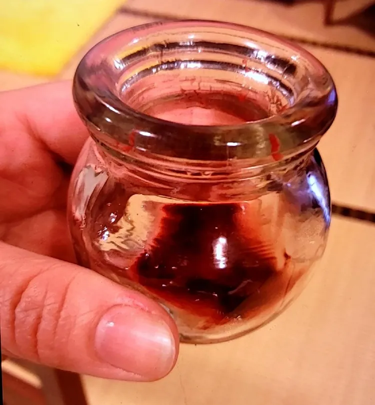 火罐拔除後可見吸出瘀血，相當恐怖。投訴人提供